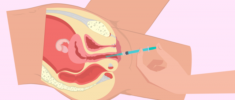 insemination-artificielle-artisanale